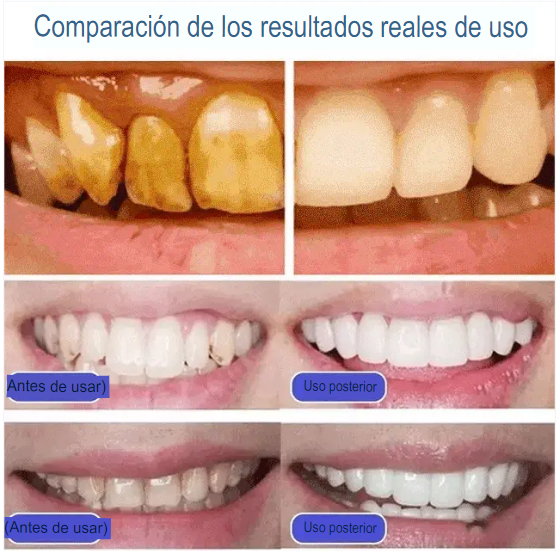 2x1 WhiteTeeth® - TRATAMIENTO BLANQUEADOR INTENSIVO