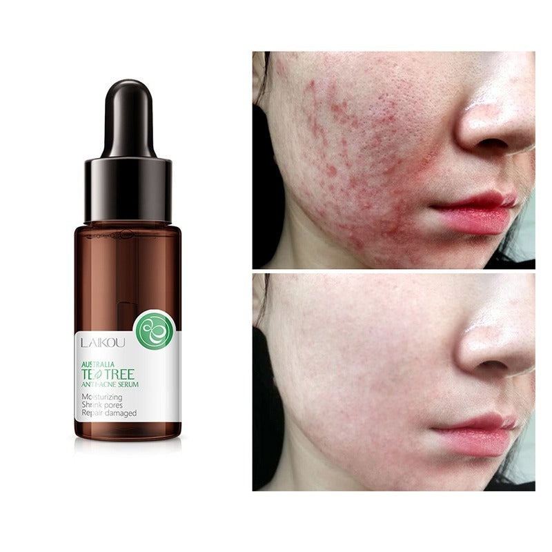 SERUM ANTI-ACNE™